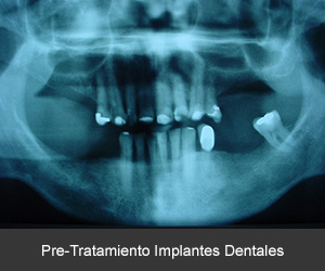 Tratamiento con Implante dentales en México