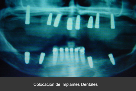 Rehabilitación bucal con implantes dentales