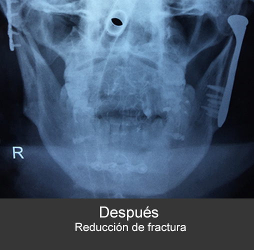 Prótesis de articulación bilateral - Cirujano Maxilofacial CDMX