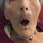 Luxación de mandíbula - Paciente de edad avanzada