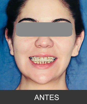 Cirugía Ortognática para corrección de Asimetría mandibular CDMX