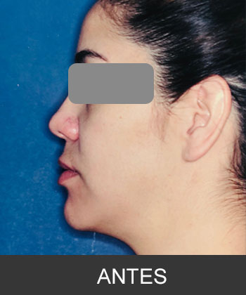 Cirugía Ortognática para corrección de Asimetría mandibular CDMX