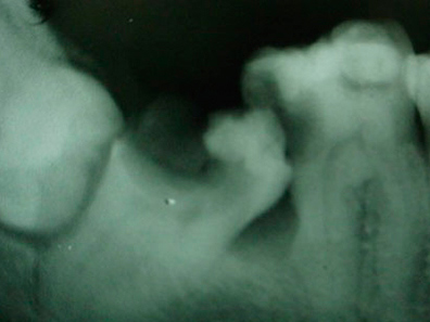Extracción de terceros molares o muelas del juicio - Cirujano Maxilofacial CDMX
