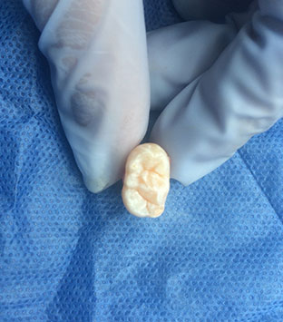 Extracción de terceros molares o muelas del juicio - Cirujano Maxilofacial CDMX