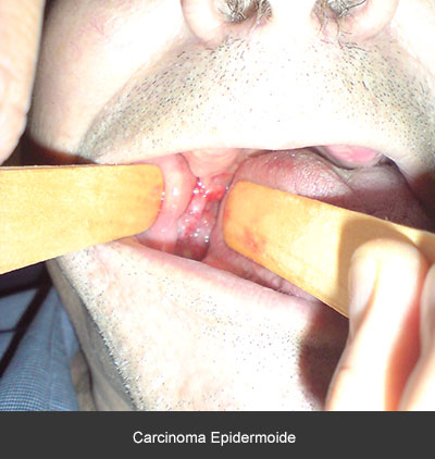 Detección carcinoma epidermoide - Cáncer bucal