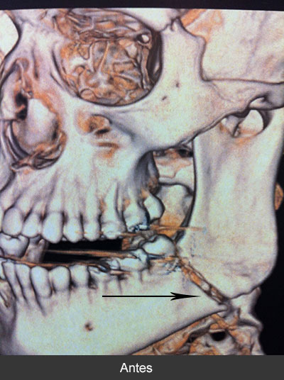 Fractura de ángulo mandibular Maxilofacial CDMX