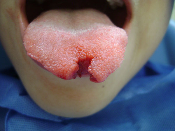 Herida en lengua Cirujano Maxilofacial CDMX