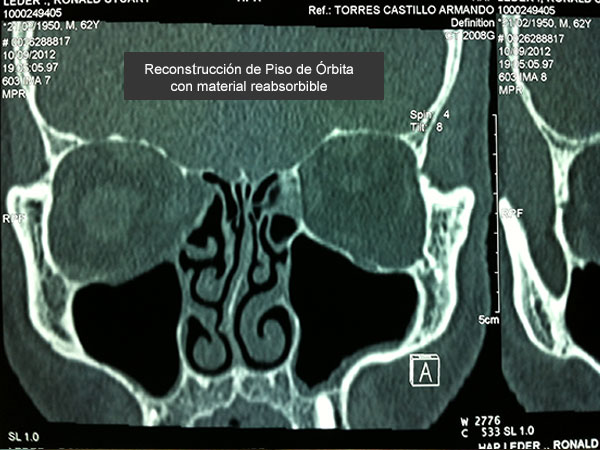 Reconstrucción Fractura de Piso de Órbita Cirujano Maxilofacial CDMX