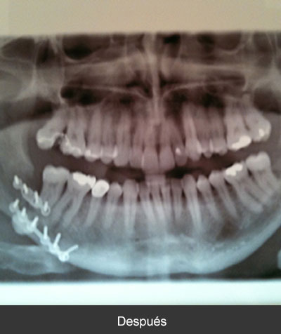 Fractura de ángulo mandibular Cirujano Maxilofacial CDMX