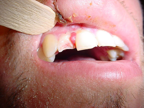 Trauma dental Maxilofacial CDMX