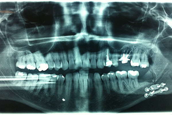 Reconstrucción Fractura mandibular Cirujano Maxilofacial CDMX