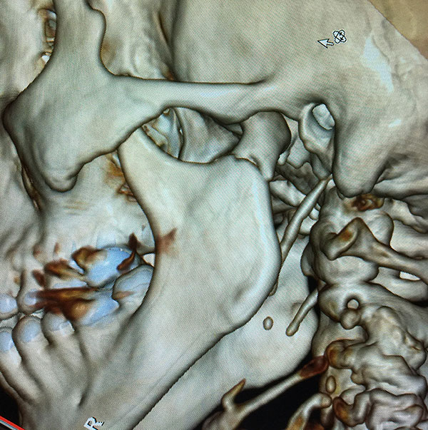 Reconstrucción Fractura mandibular Cirujano Maxilofacial CDMX