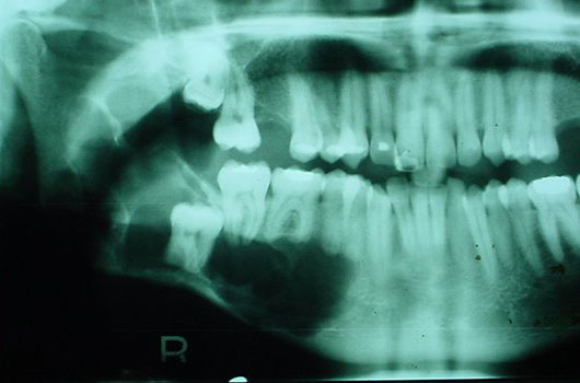 Queratoquiste asociado a tercer molar - Cirujano Maxilofacial 