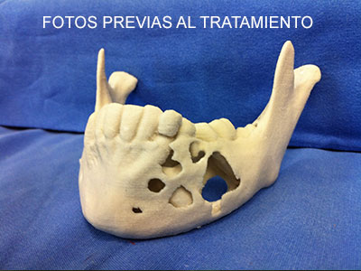 paciente con queratoquiste asociado a un diente incluido - Cirujano Maxilofacial