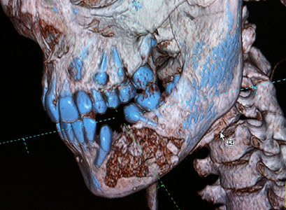 paciente con queratoquiste asociado a un diente incluido - Cirujano Maxilofacial