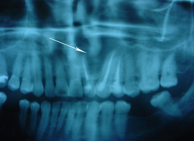 Quiste dentrígeo - Cirugía Maxilofacial