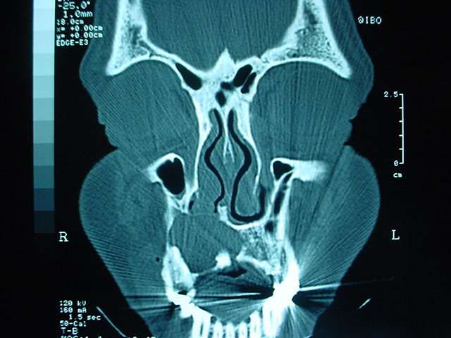 Cirugía Ortognática para corrección de Prognatismo Mandibular CDMX