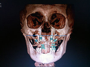 CAD CAM Crujano Maxilofacial en CDMX