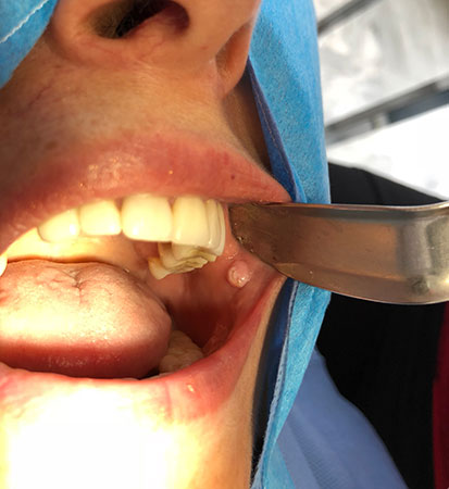 Retiro de fibroma en mucosa bucal