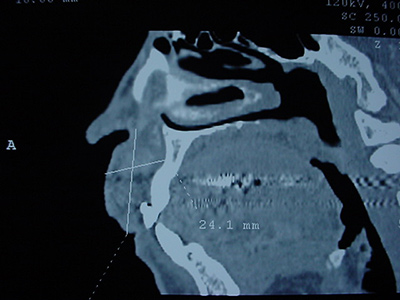 Cirujano Maxilofacial CDMX Hemangioma labial