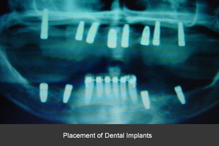 Rehabilitación bucal con implantes dentales