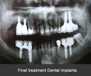 resultado final implantes dentales