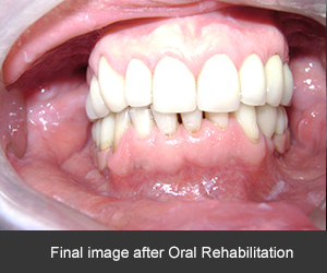 rehabilitacion bucal con implantes dentales