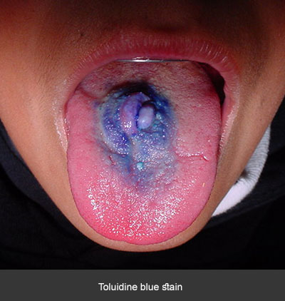 Tinzión con azul de toluidina - Cáncer bucal