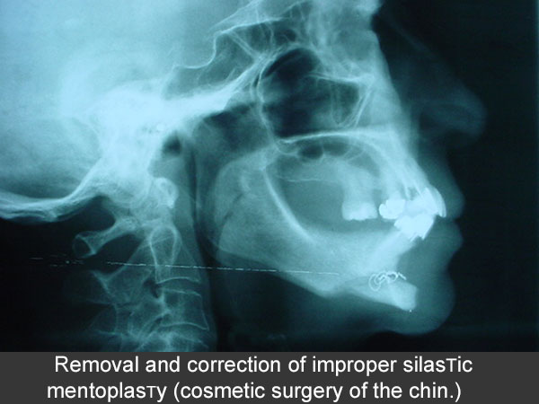Retiro de Implantes de Silastic por infección en Maxilofacial CDMX