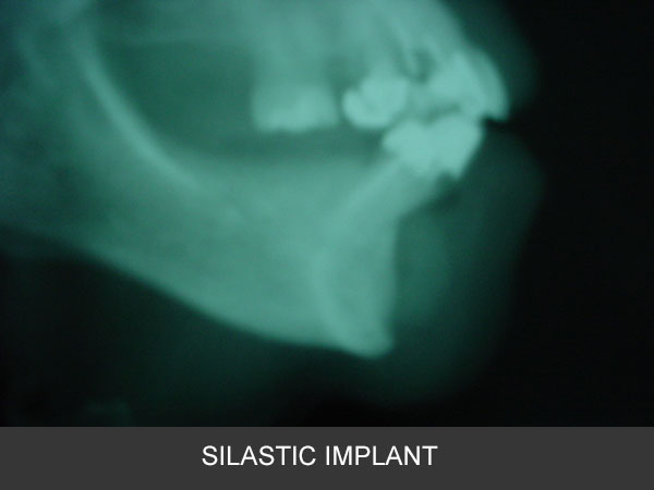 Retiro de Implantes de Silastic por infección en Maxilofacial CDMX